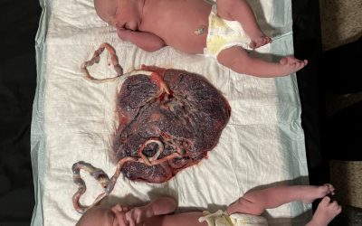 #84 | She Fired Her OB and Delivered Mono-Di Twins Pain-Free at Home